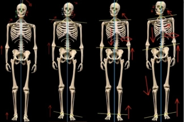 Postural Analysis Issues - Massage In York