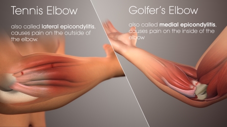 Tennis Elbow Golfers Elbow Anatomy