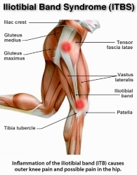 IT Band Anatomy