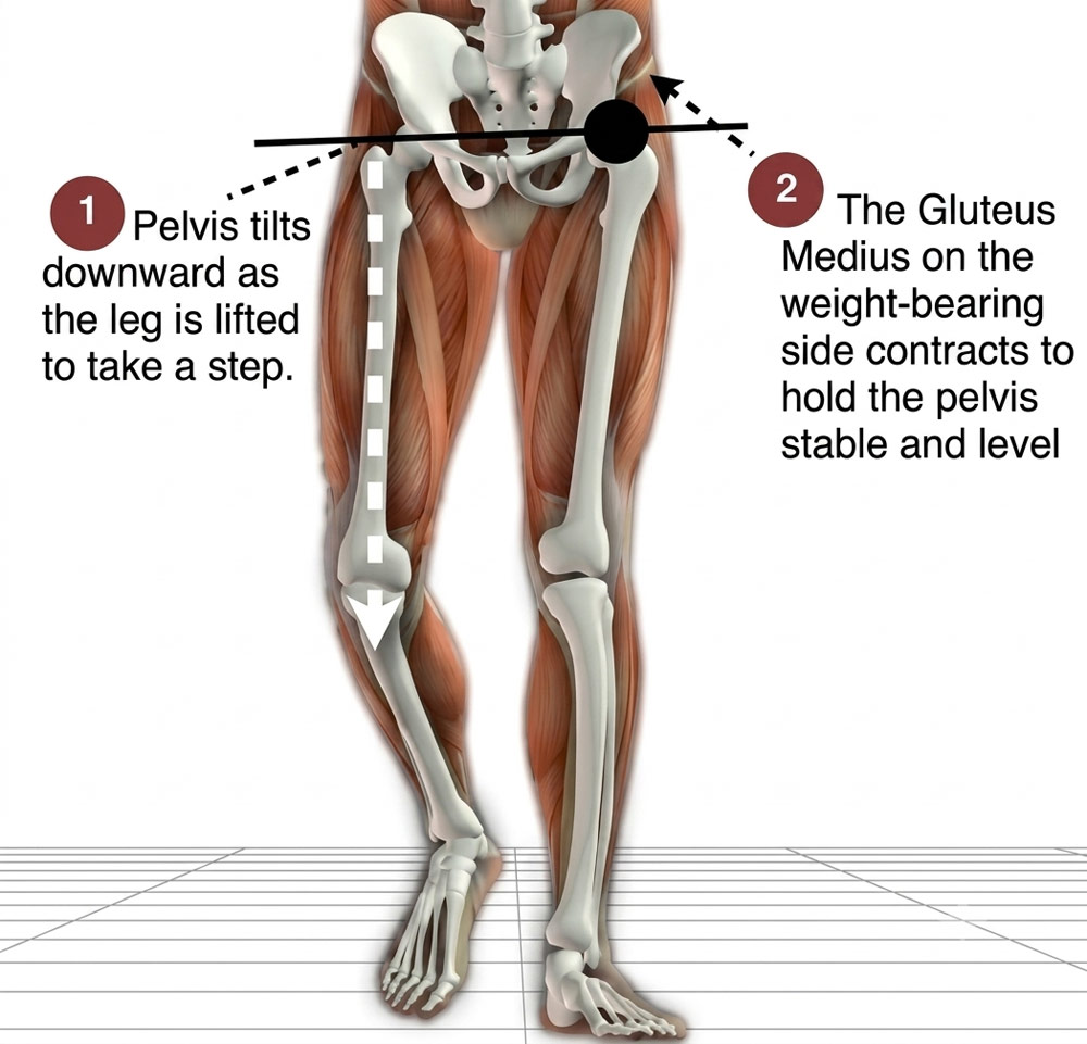 Anatomical diagram demonstrating a pelvic tilt and hip drop caused by weak or inhibited gluteus medius muscle function during a step, leading to compensatory lower back strain.