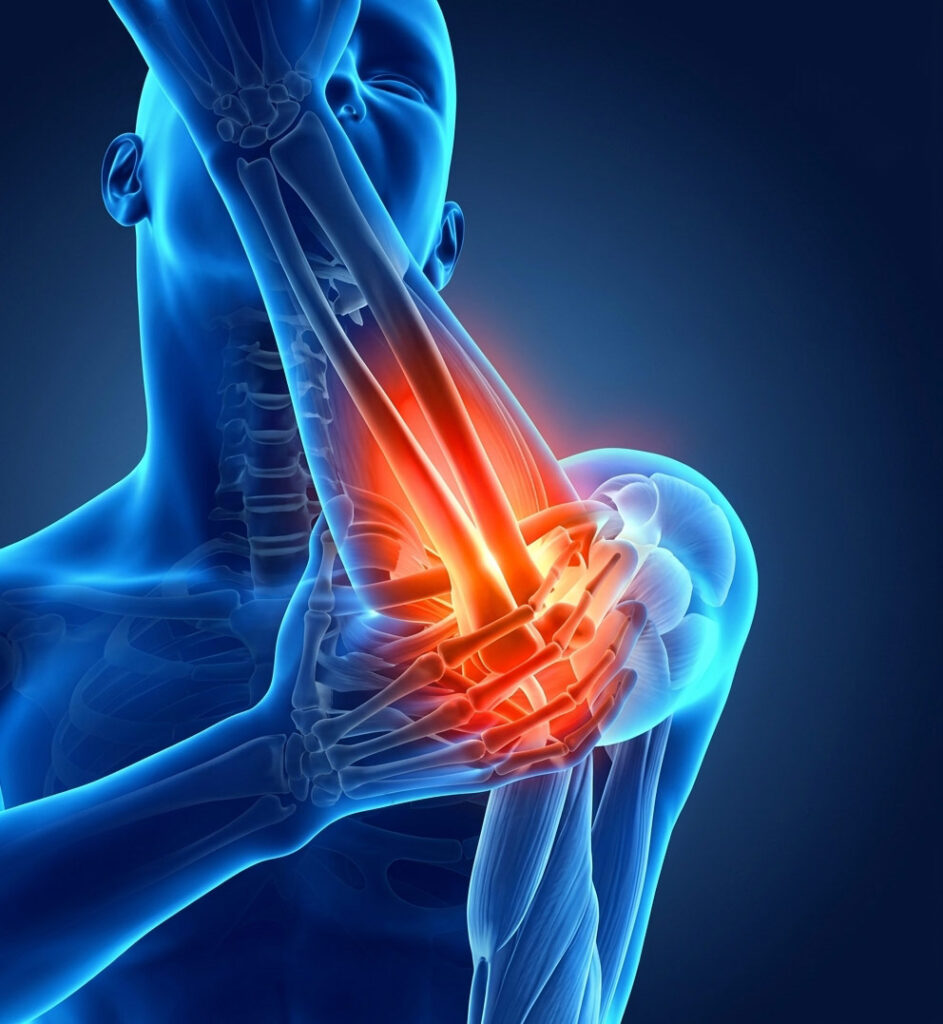 3D anatomical illustration of inflamed elbow joint tendons treated with sports massage therapy in York.