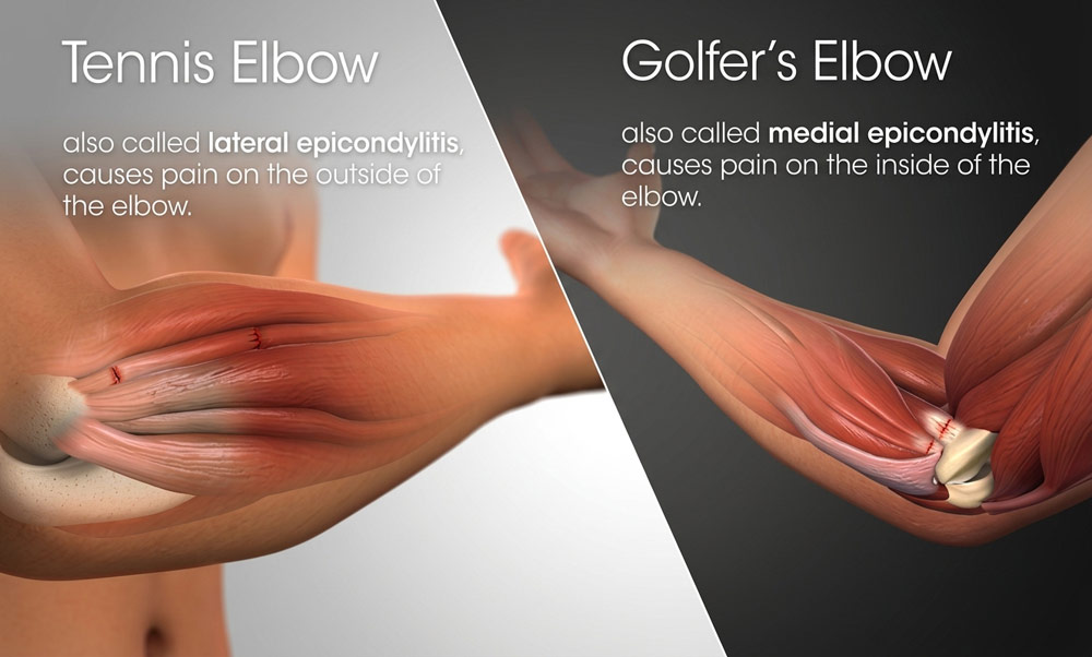 Comparison diagram showing lateral epicondylitis (tennis elbow) and medial epicondylitis (golfer's elbow) addressed through mobile sports massage in York.