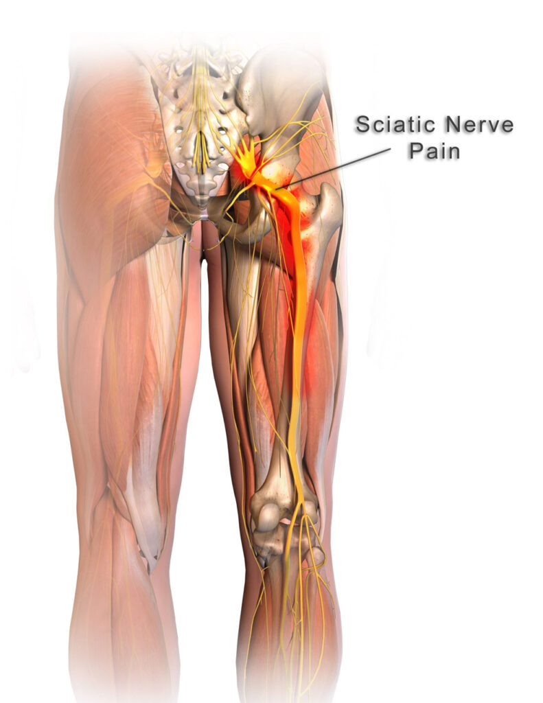 Optimised Alt Text: Anatomical diagram from behind showing the path of the sciatic nerve running from the pelvis down the leg, highlighting nerve compression and pain in the deep gluteal region.
