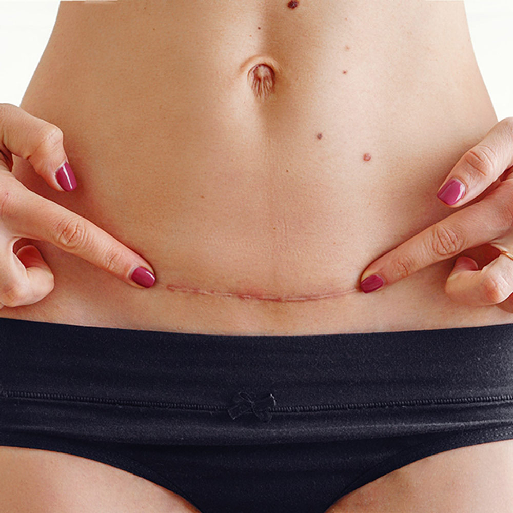 Close-up of a woman pointing to a horizontal C-section scar on her lower abdomen.
