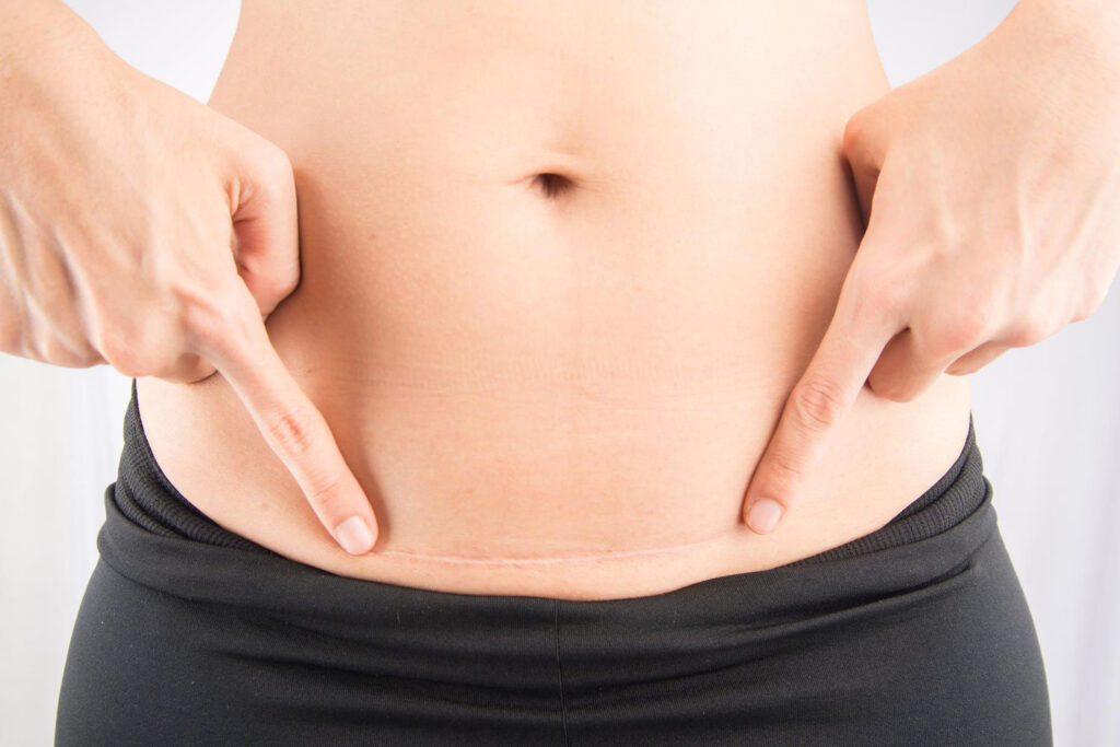 Close-up of a woman pointing to a faint, well-healed horizontal C-section scar on her lower stomach after massage treatment.